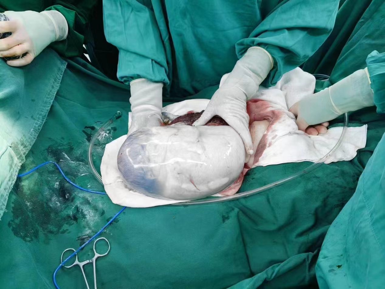 早产龙宝带“壳”降生！建水县人民医院成功开展保留胎膜囊（Encaul）剖宫产术